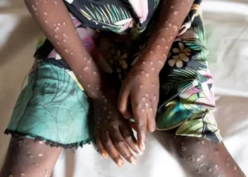 POR MPOX O VIRUELA DE MONO Declara OMS emergencia sanitaria internacional