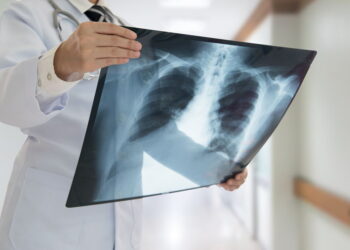 PREOCUPA A SECRETARÍA DE SALUD Reportan 254 casos de tuberculosis y 27 decesos