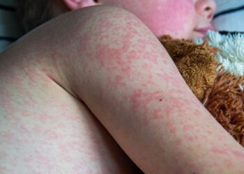 Emiten aviso epidemiológico por sarampión y tosferina