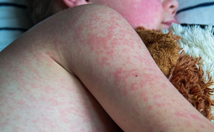 Emiten aviso epidemiológico por sarampión y tosferina