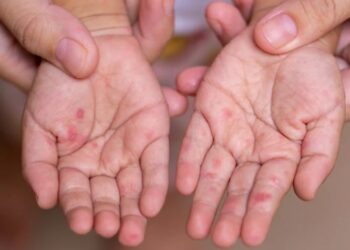 Descartan casos de virus de sarampión en Laredo-Webb