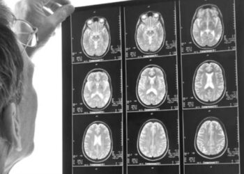 Derrames cerebrales afectan ya a población de jóvenes adultos
