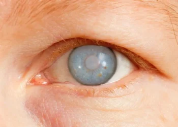 Glaucoma amenaza visión sin síntomas iniciales claros