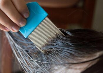 EN PRIMARIAS Detectan hasta 90% de alumnos con pediculosis