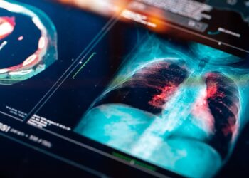 El cáncer de pulmón sigue siendo el tumor más mortal, sólo 3 de cada 10 pacientes sobreviven a los cinco años.