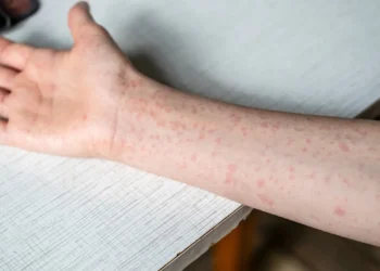 Alertan por expansión de sarampión