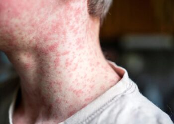 ENFERMEDAD PUEDE SER LETAL Libre Nuevo Laredo de sarampión