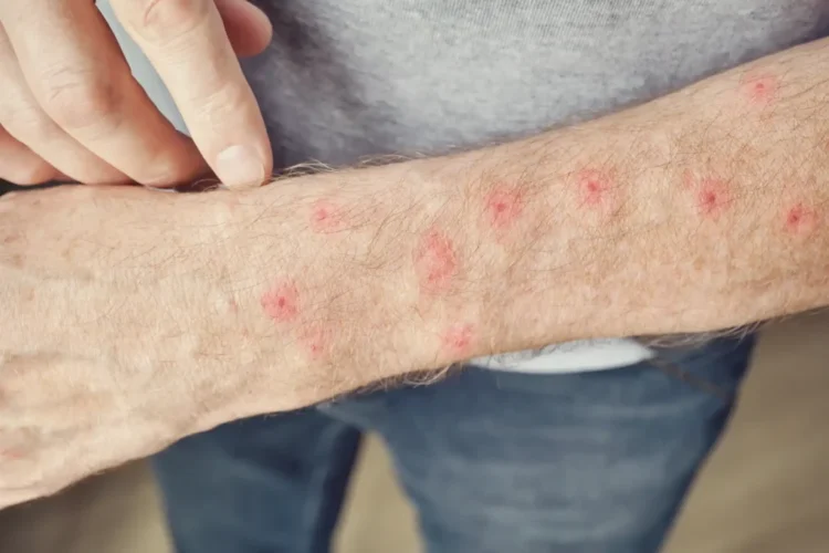 No toda erupción cutánea es sarampión: SSA