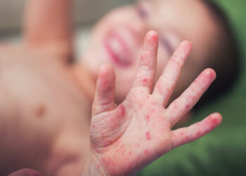 ENFERMEDAD DE MANOS, PIES Y BOCA Detectan virus en primaria