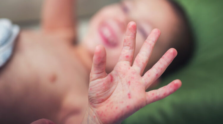 ENFERMEDAD DE MANOS, PIES Y BOCA Detectan virus en primaria