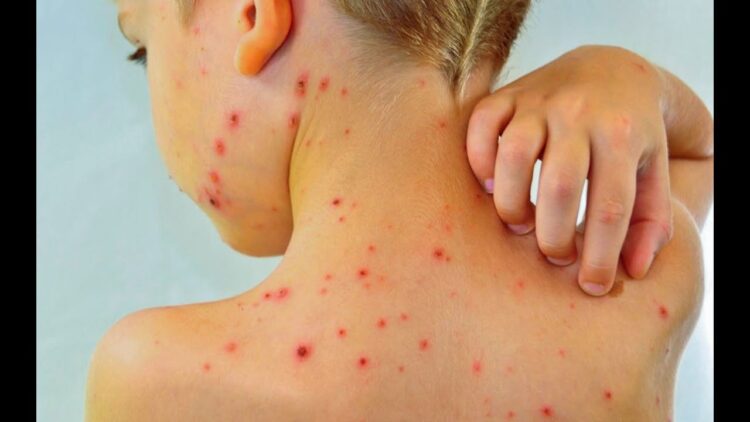 Instan a vacunarse contra sarampión