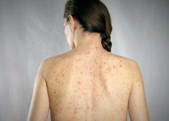 ESTO DEBES SABER ¿Eres inmune al sarampión?