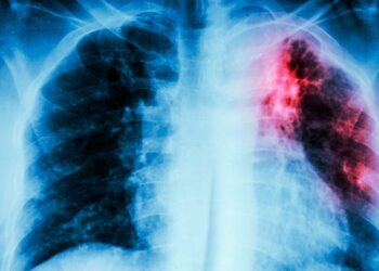 Registran 54 casos de tuberculosis