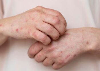Descartan ébola y el sarampión