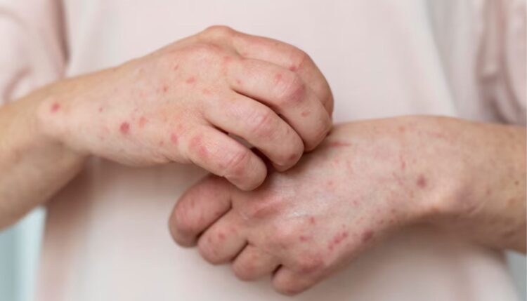 Descartan ébola y el sarampión