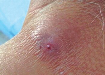 Llaman a vigilar heridas para evitar miasis