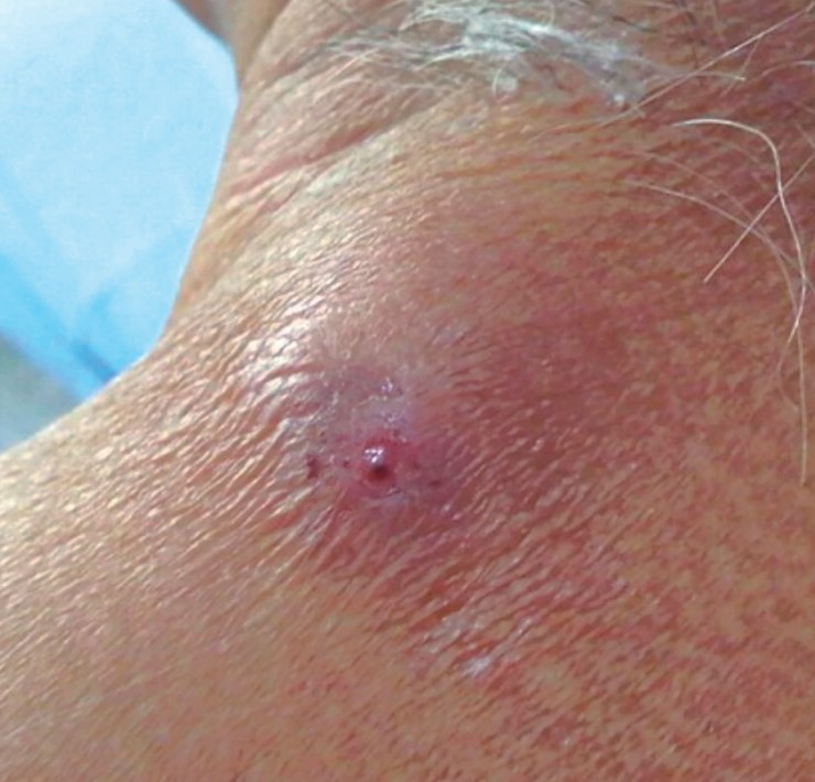 Llaman a vigilar heridas para evitar miasis